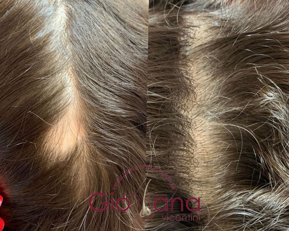 Resultado antes e depois de tratamento capilar 01