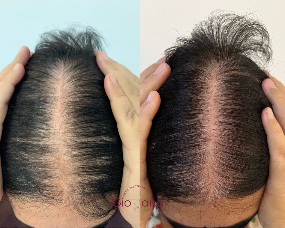Resultado antes e depois de tratamento capilar 02