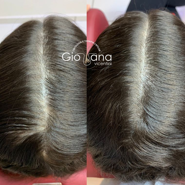 Resultado antes e depois de tratamento capilar 03