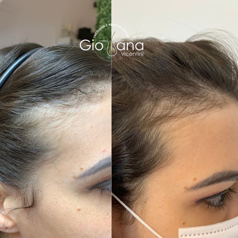Resultado antes e depois de tratamento capilar 04