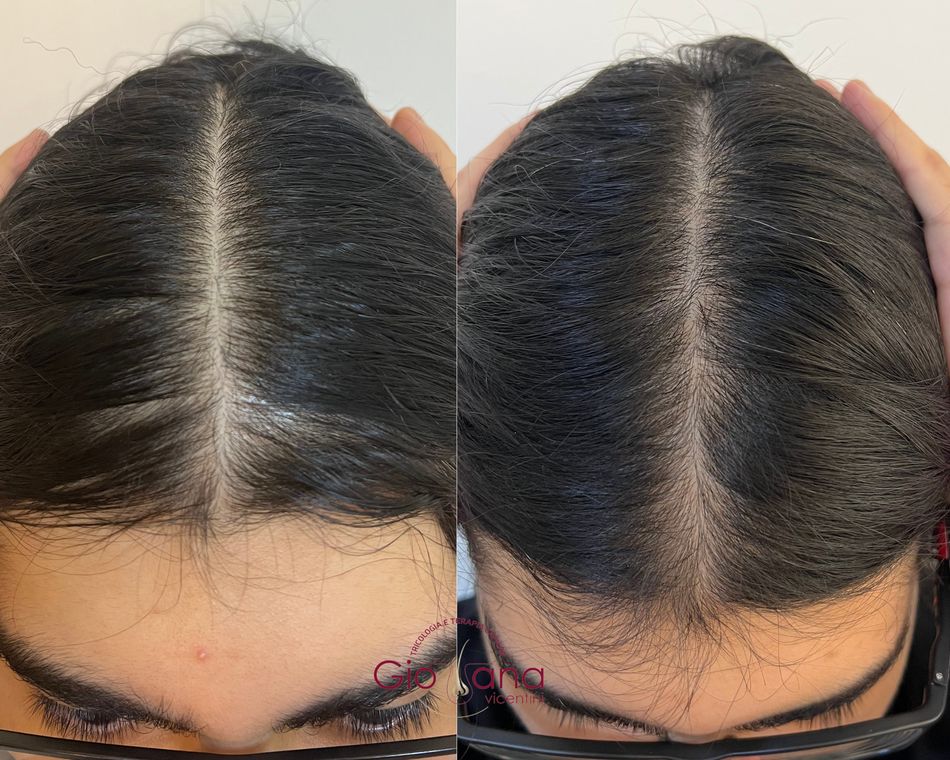 Resultado antes e depois de tratamento capilar 05