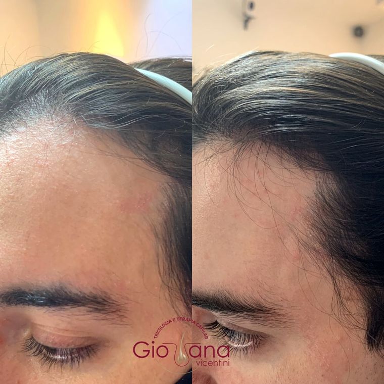 Resultado antes e depois de tratamento capilar 06