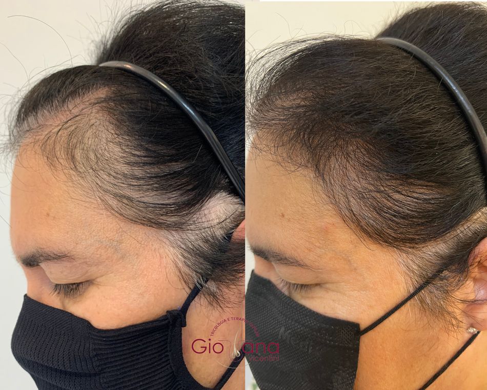 Resultado antes e depois de tratamento capilar 07
