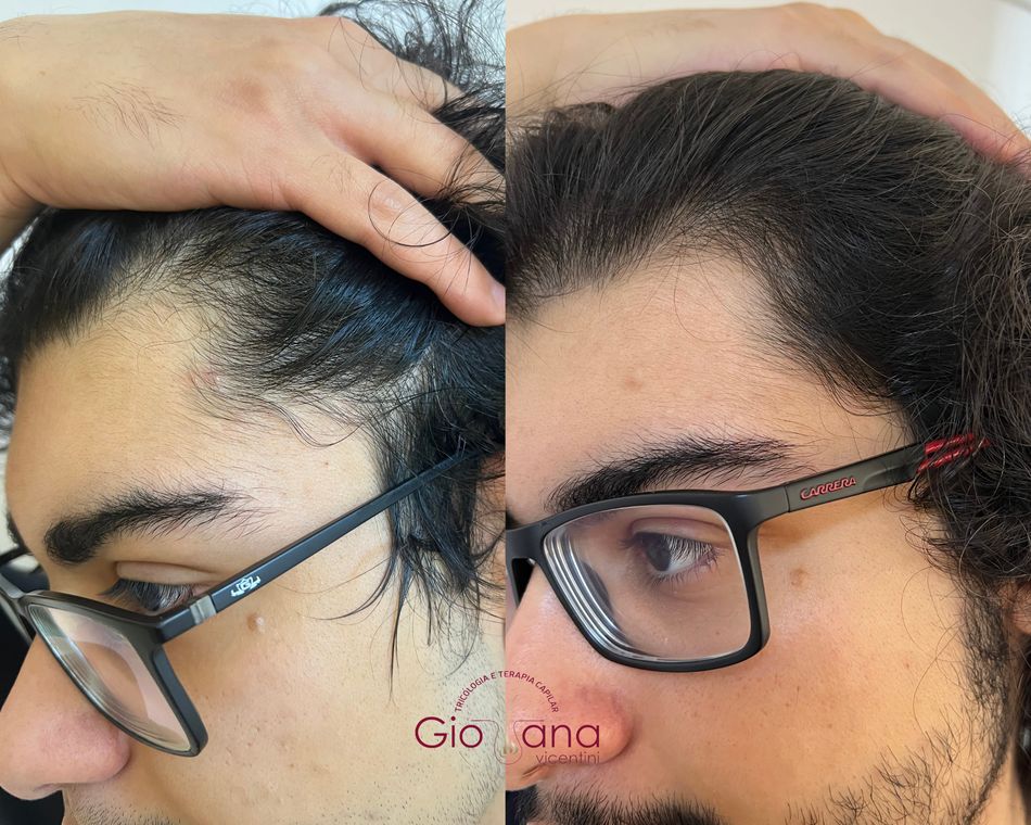 Resultado antes e depois de tratamento capilar 08