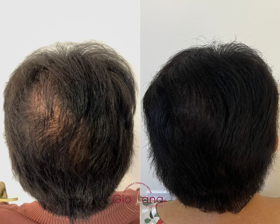 Resultado antes e depois de tratamento capilar 09