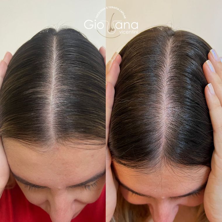 Resultado antes e depois de tratamento capilar 10
