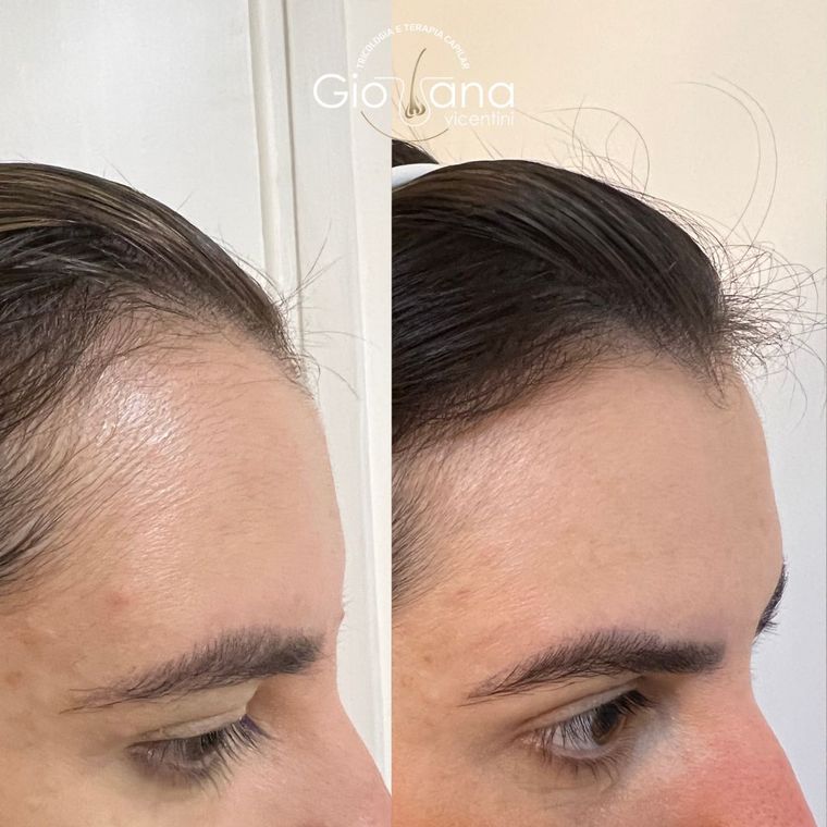 Resultado antes e depois de tratamento capilar 11