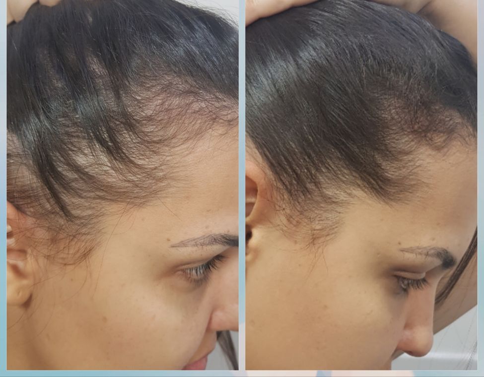 Resultado antes e depois de tratamento capilar 12