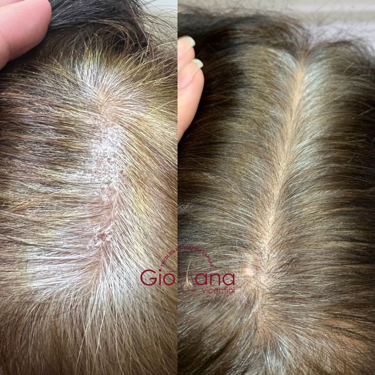 Resultado antes e depois de tratamento capilar 13