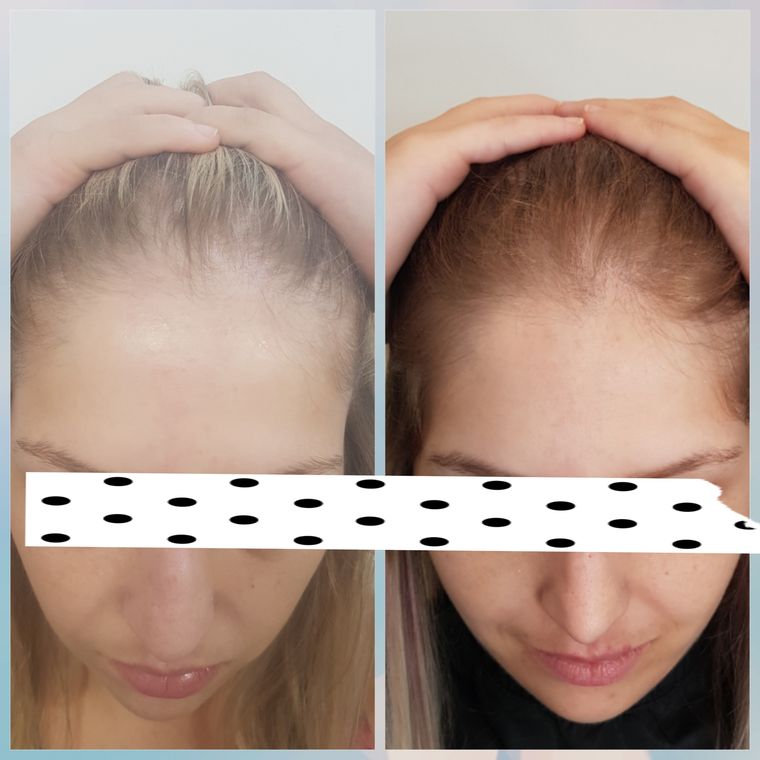 Resultado antes e depois de tratamento capilar 14