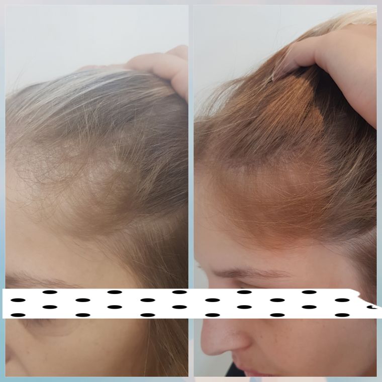 Resultado antes e depois de tratamento capilar 15