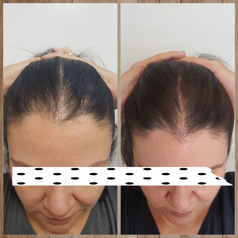 Resultado antes e depois de tratamento capilar 17
