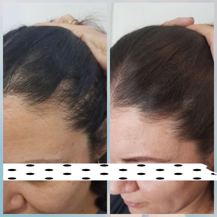 Resultado antes e depois de tratamento capilar 18