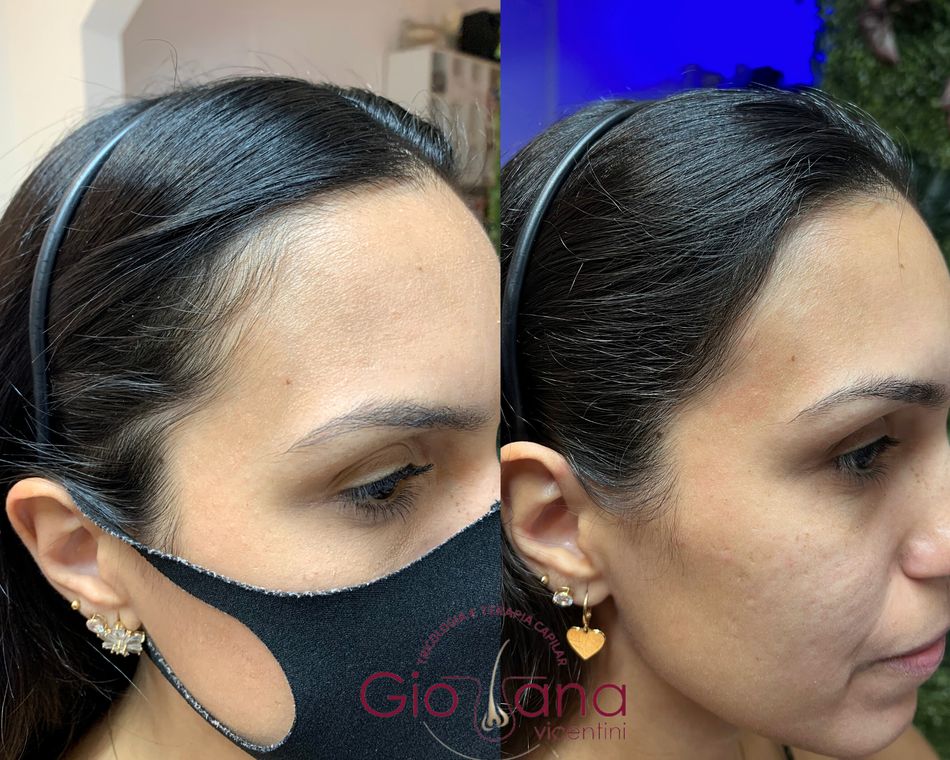 Resultado antes e depois de tratamento capilar 20