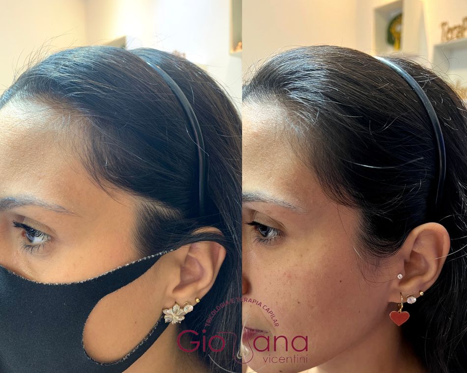 Resultado antes e depois de tratamento capilar 21