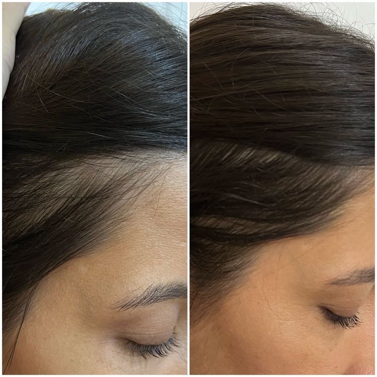Resultado antes e depois de tratamento capilar 22